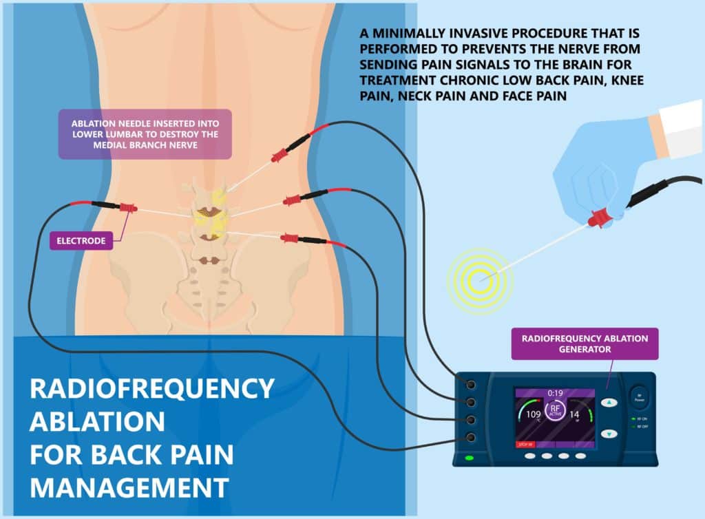 RFA low arm leg hip pain back neck knee pars bone nerve treat joint spine block Local radio needle relief branch Lumbar spinal damage pelvis therapy lateral chronic vertebra cervical surgical medial