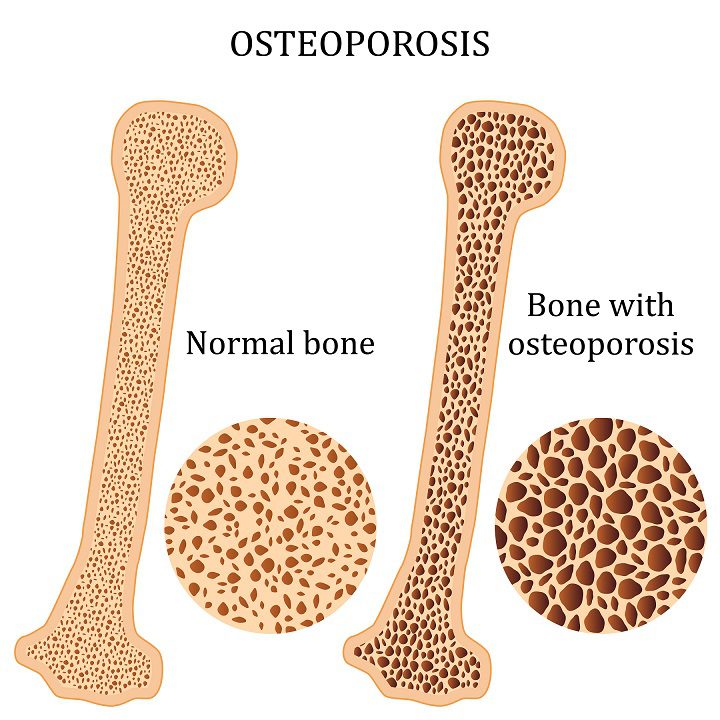 illustration of bone with osteoporosis
