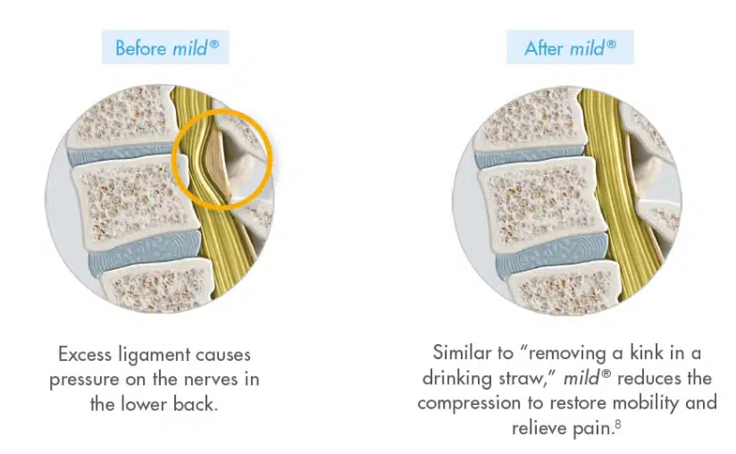 Minimally Invasive Lumbar Decompression procedure before and after spine illustration