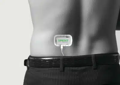 SPRINT PNS device on back
