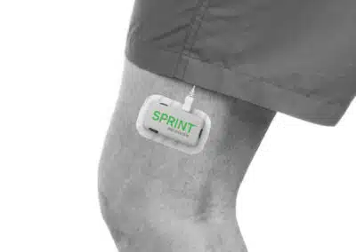 SPRINT PNS device on knee