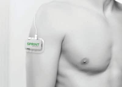 SPRINT PNS device on arm