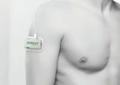 SPRINT PNS device on arm