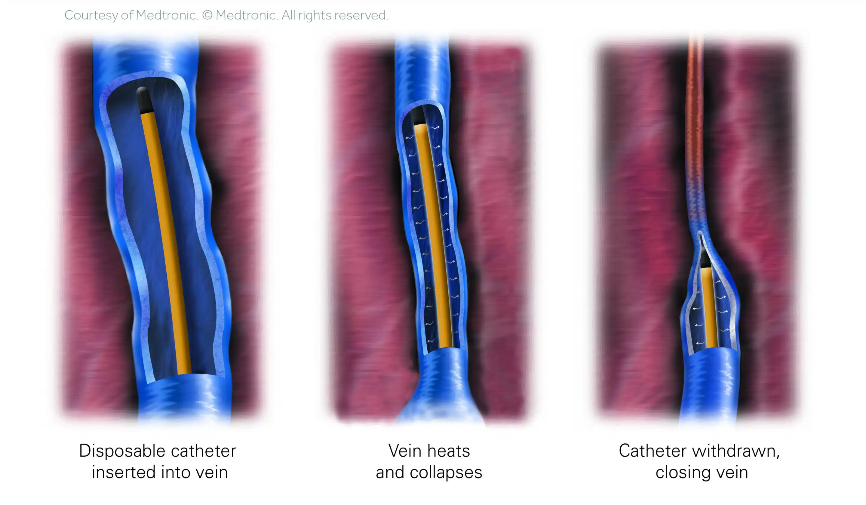 ClosureFast procedure 3 step vein illustration