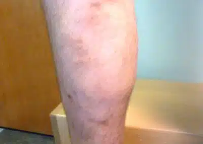 CVI patient 2 after vein care procedure