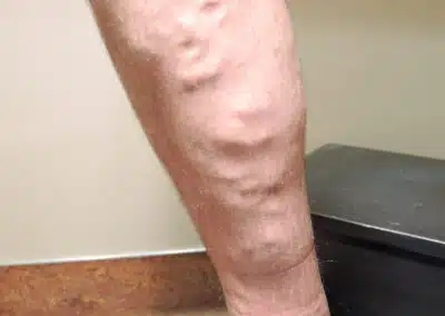 CVI Patient 2 before vein care procedure