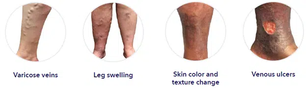 image examples of varicose veins, leg swelling, skin color change, venous ulcers