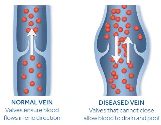 chronic venous insufficiency vein diagram