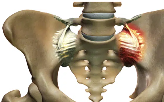 Illustration of pelvis SI joint pain