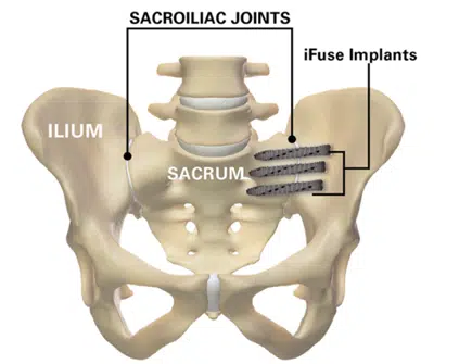 iFuse TORQ implant illustration in pelvis